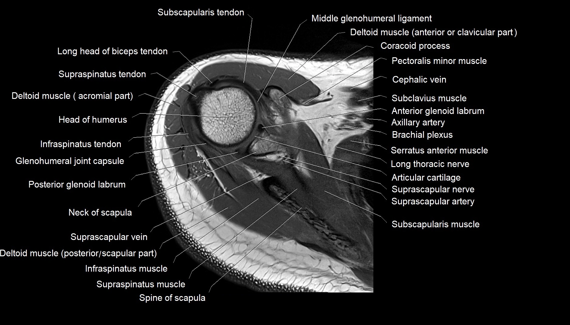 Shoulder cross sectional anatomy MRI 3T axial image 14.webp